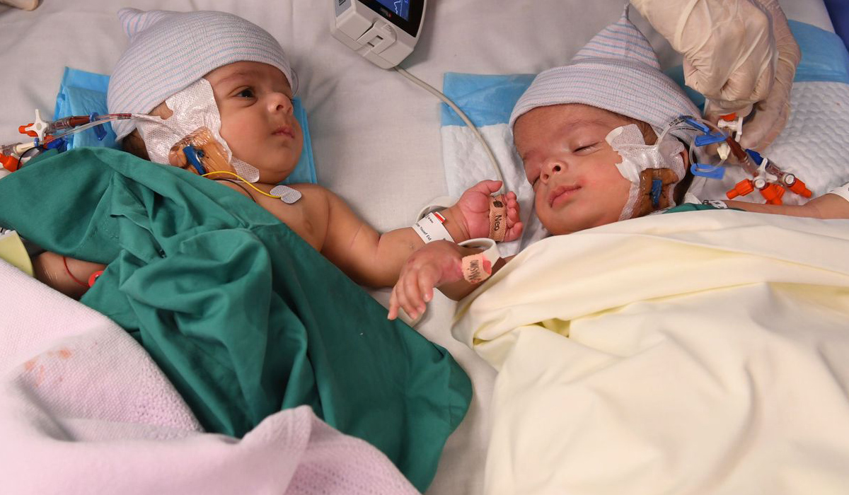 Conjoined Yemeni twins Salman and Abdullah successfully separated